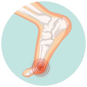Read more about the article How Long Does a Rolled Ankle Take to Heal?